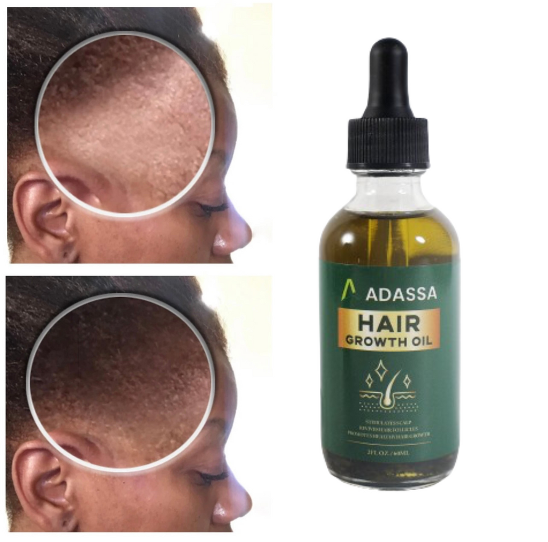 Adassa hair Growth Oil